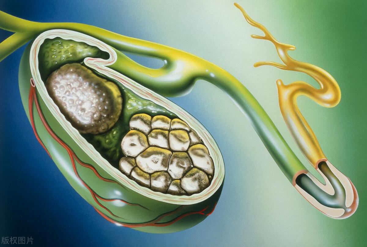 年轻人得了充满型胆囊结石怎么办,胆囊充满型结石十几年不切除