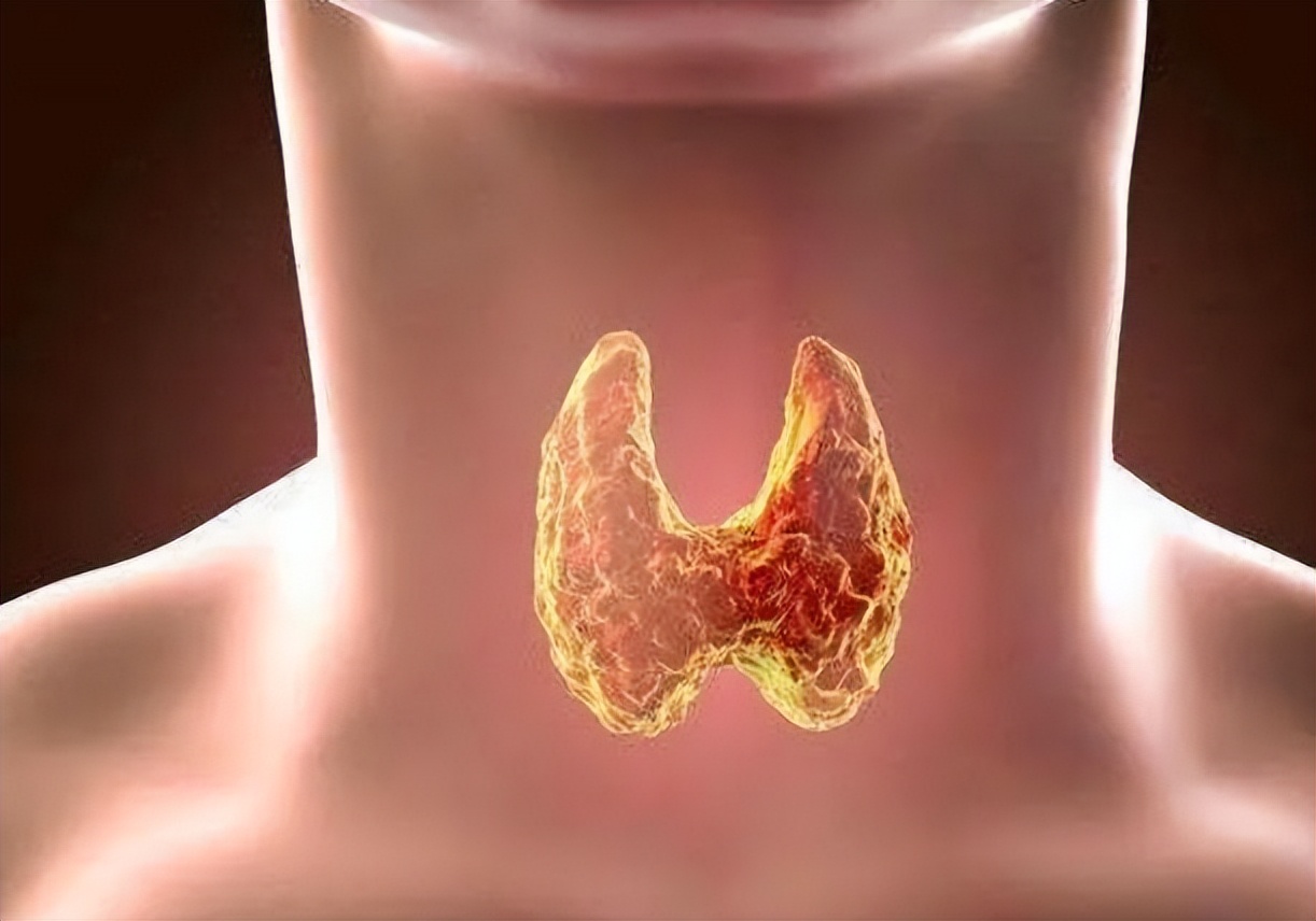 桥本氏甲状腺炎可以吃黄豆吗,甲状腺结节可以吃黄豆和红薯吗