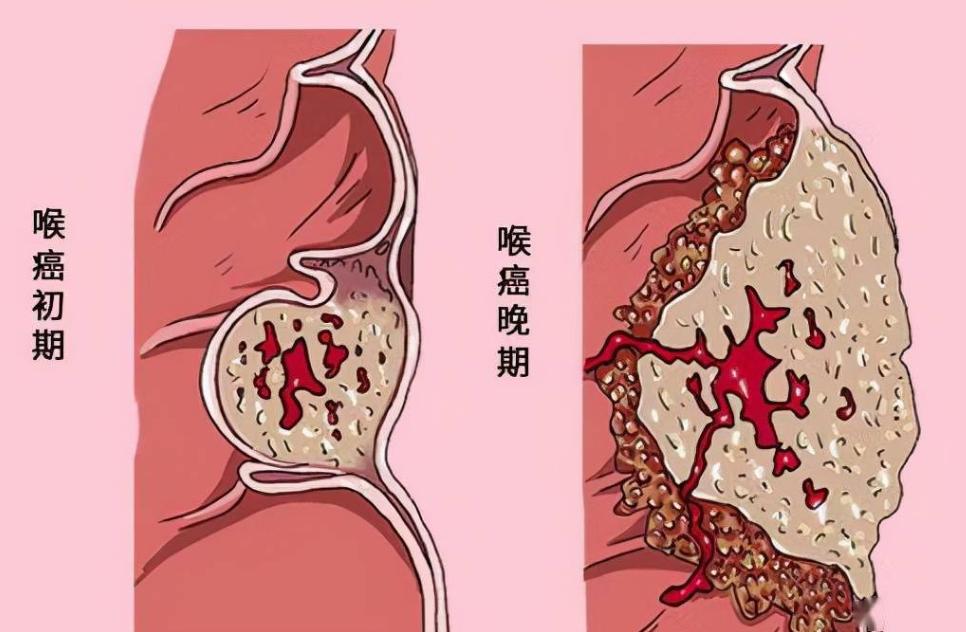 全喉切除术治疗喉癌的缺点,喉癌手术切除后吞咽困难怎么办