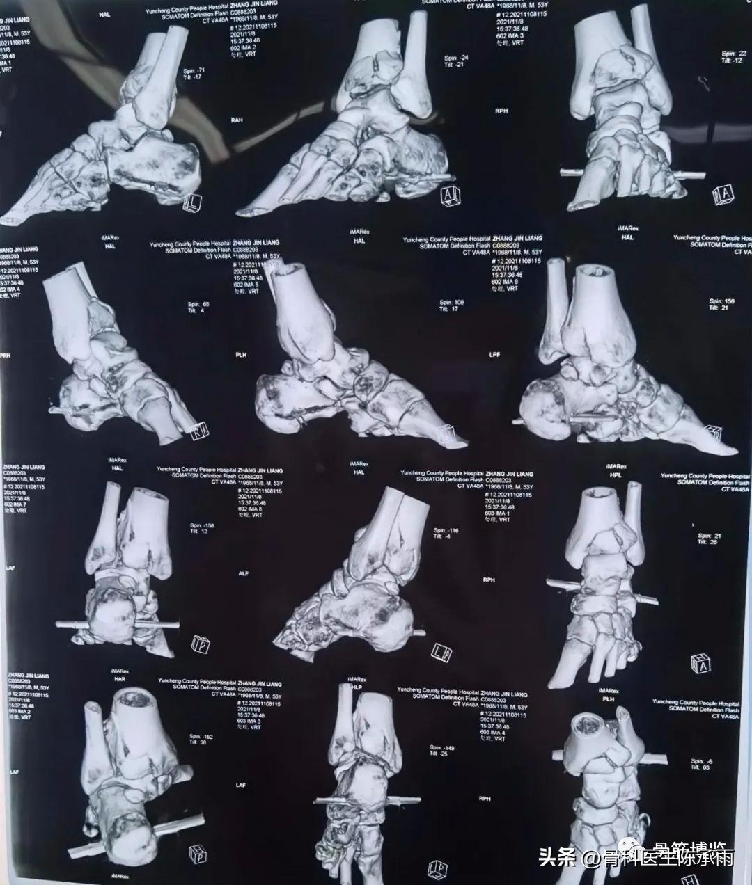 胫骨开放性骨折处理方法,胫骨腓骨开放性骨折能评几级伤残