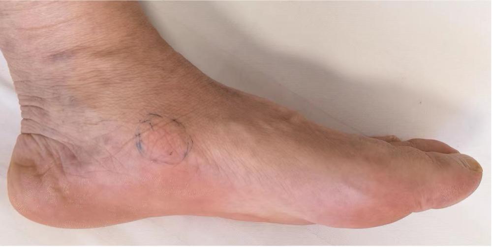 太马来了，跑友们要注意足踝部的运动损伤！