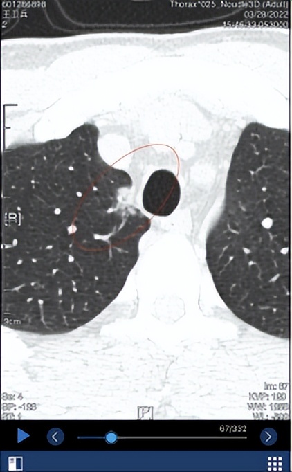 肺部磨玻璃结节0.5*0.4需要手术吗,肺部6mm*9mm的磨玻璃结节问题大吗