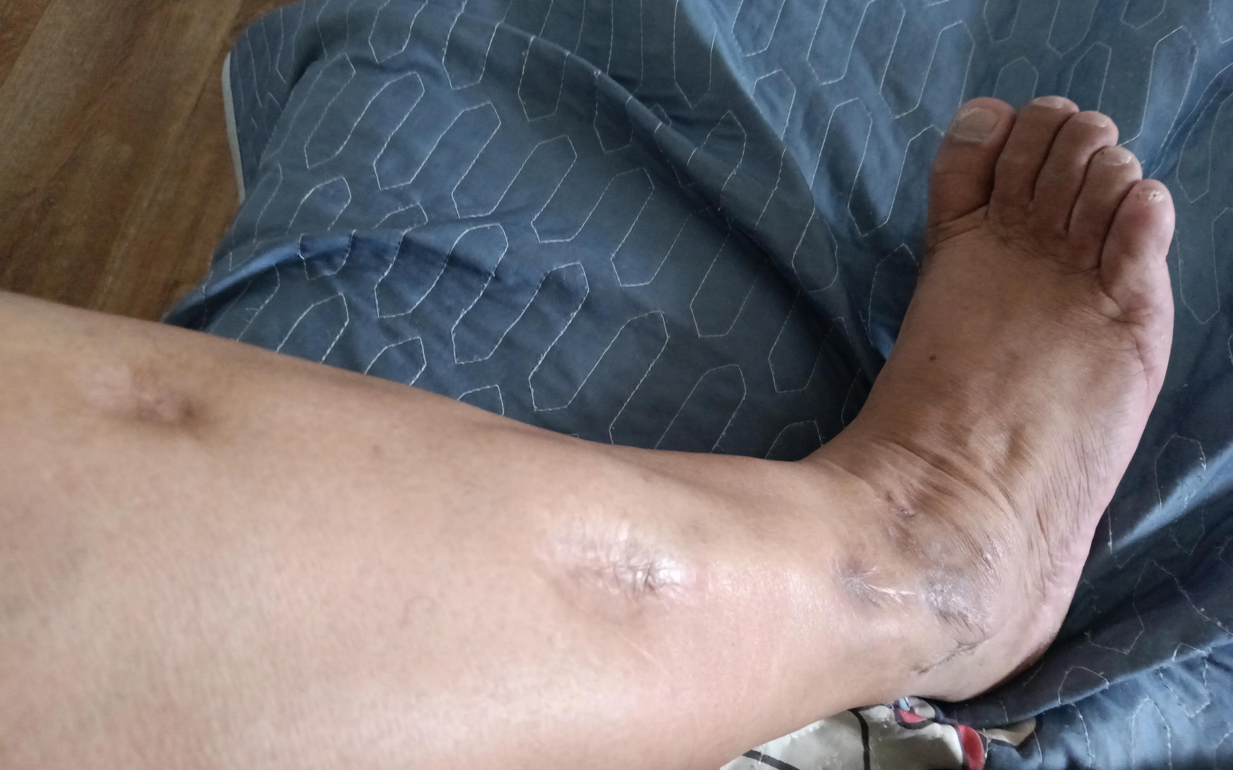 慢性骨髓炎手术后还会复发吗,慢性骨髓炎终生不复发