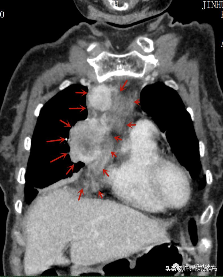 这位老乡，乏力来查，查出这么大个的纵隔肿瘤！会是什么呢？
