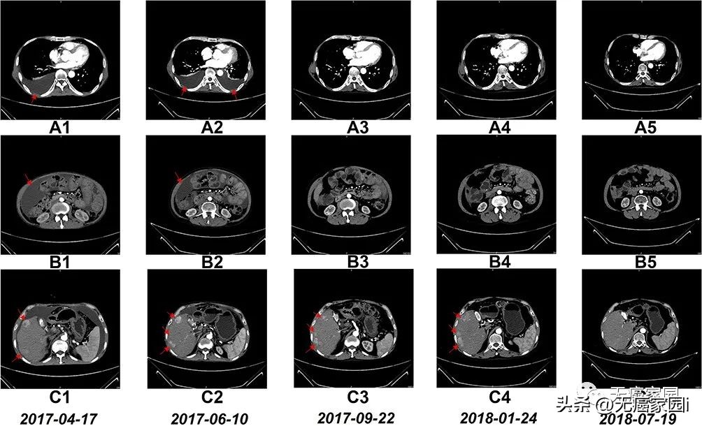 抗癌新技术真的出来了吗,最新靶向抗癌新药