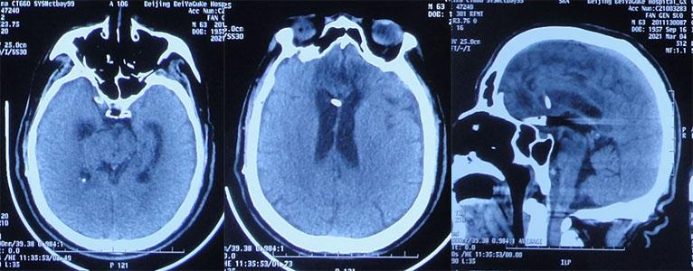 前交通动脉瘤破裂后开颅治疗风险,脑前交通动脉瘤破裂出血