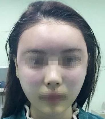 自体脂肪填充泪沟会改善细纹么,自体脂肪填充不满意怎么办