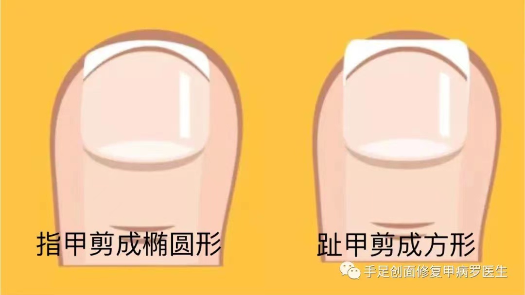 老年人厚指甲修剪过程,老年人脚趾甲厚修剪用什么剪刀