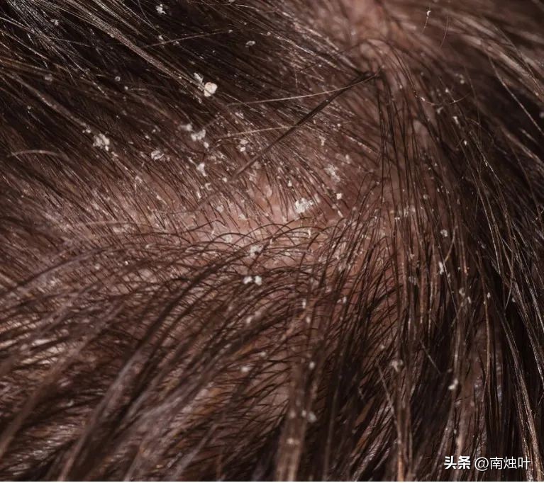 头油头痒头屑掉头发怎么治疗,头屑多头皮痒油头有什么好妙招