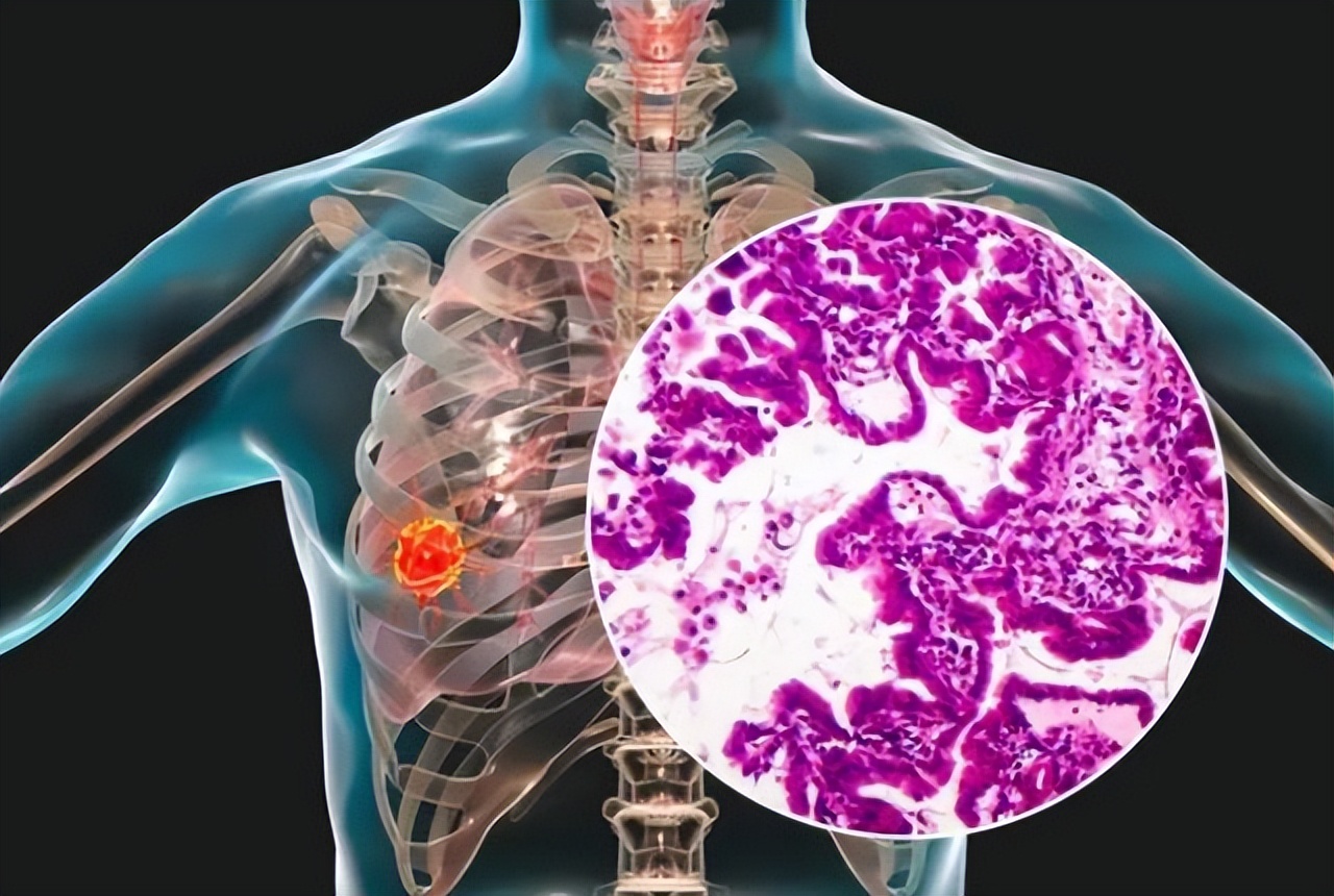 癌症不治疗医生大实话,发现癌症不能动手术