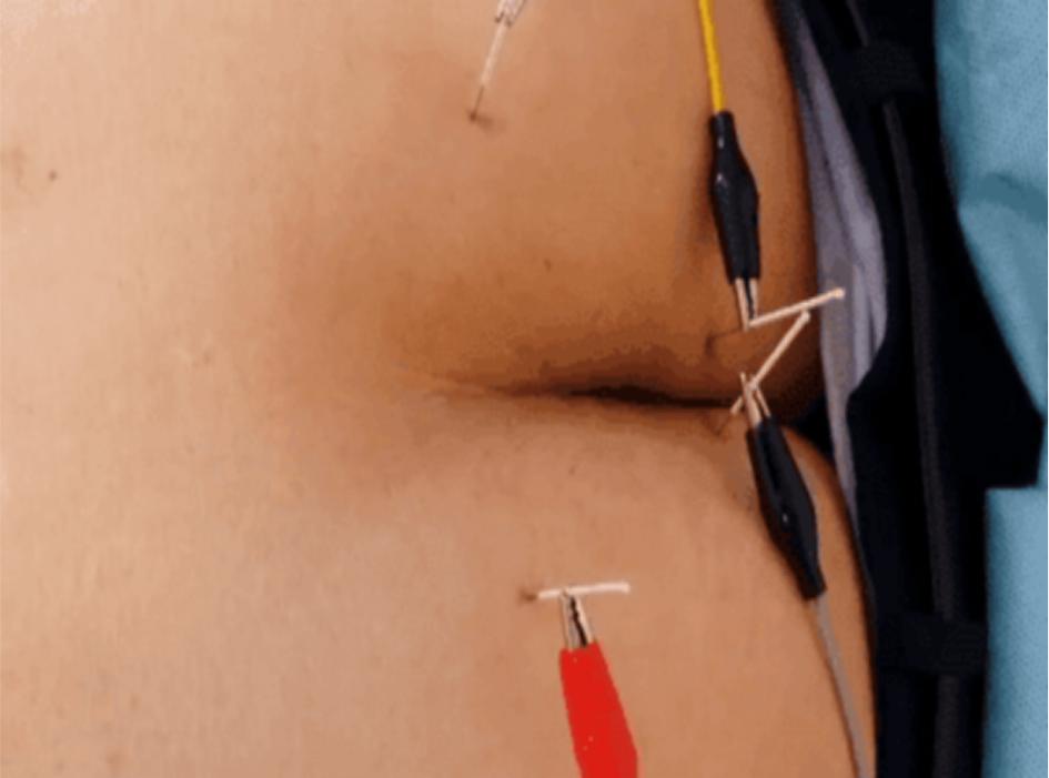 阴部神经电针刺激联合盆底肌锻炼治疗前列腺癌术后尿*禁失**