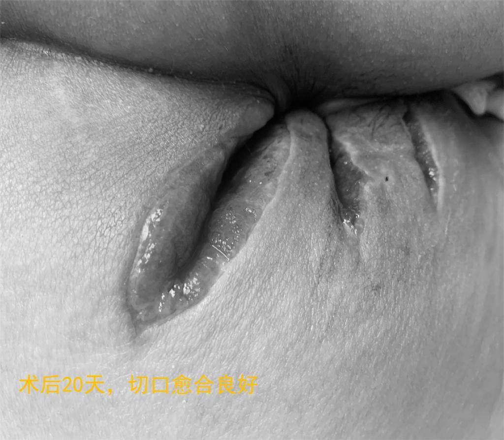 痔疮跟肛周脓肿的区别中医怎么讲,肛周肿痛误为痔疮