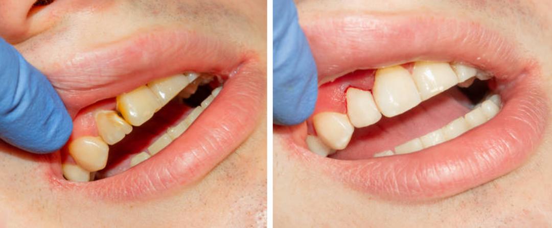 牙缝每天都塞牙怎么办,塞牙缝有彻底解决办法