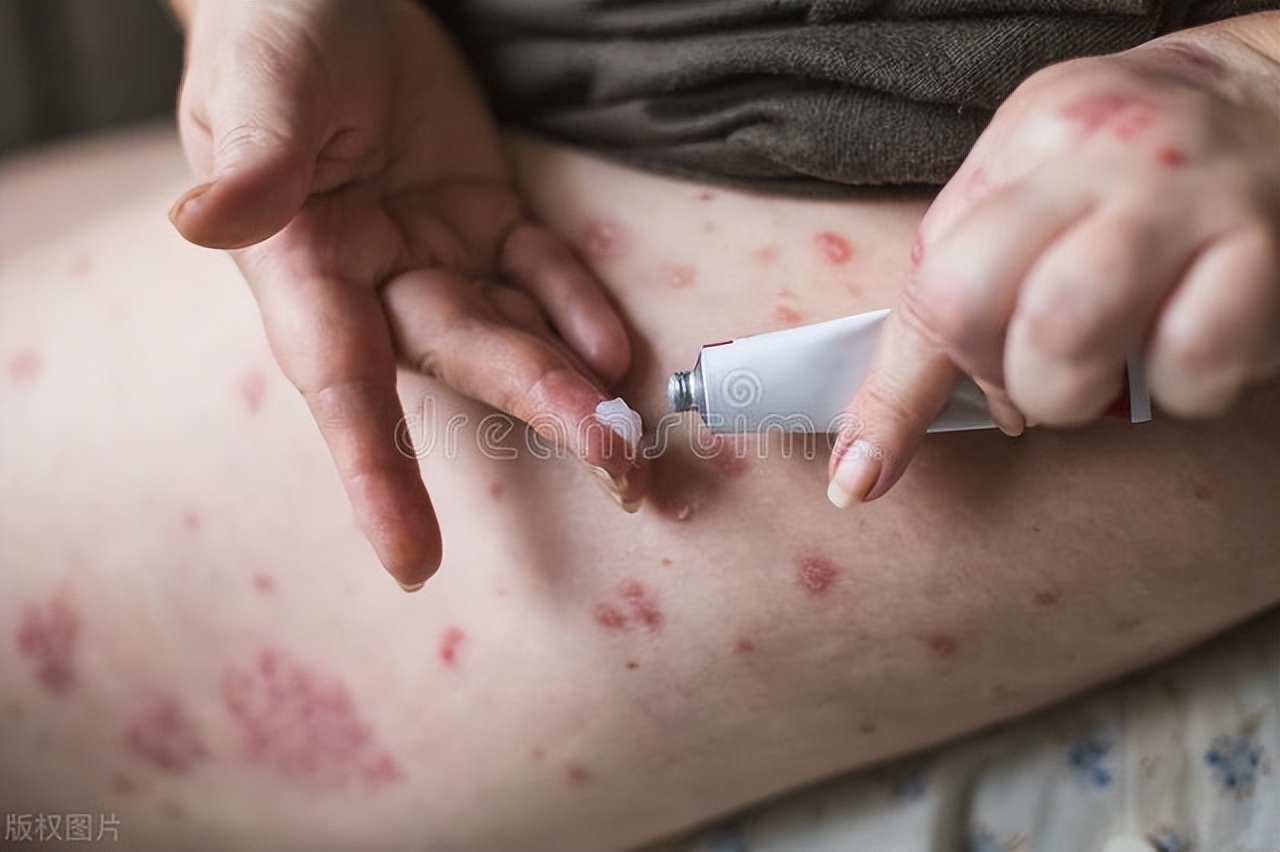 亲戚卧床引发惊恐，媳妇*裤内**惊现红点痒感，就医惊现阴虱真相