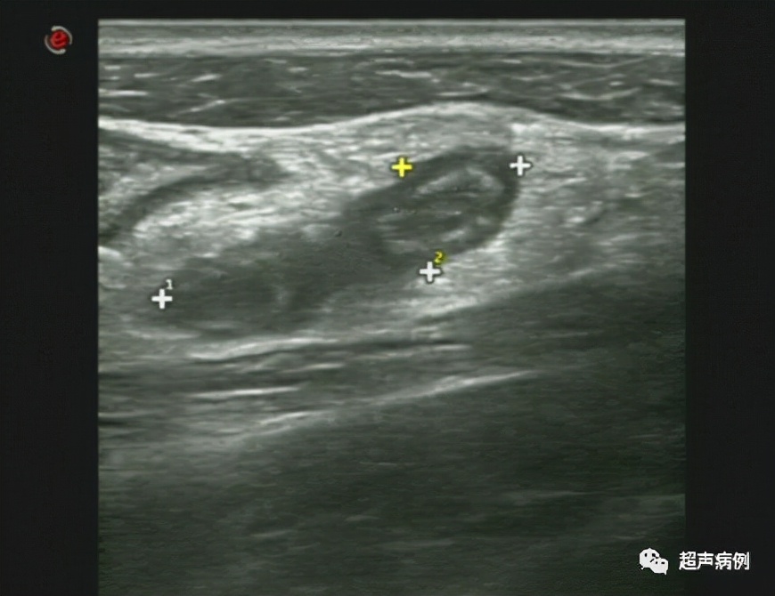阑尾炎超声下怎么看？哪些知识需要掌握？这里都总结好了