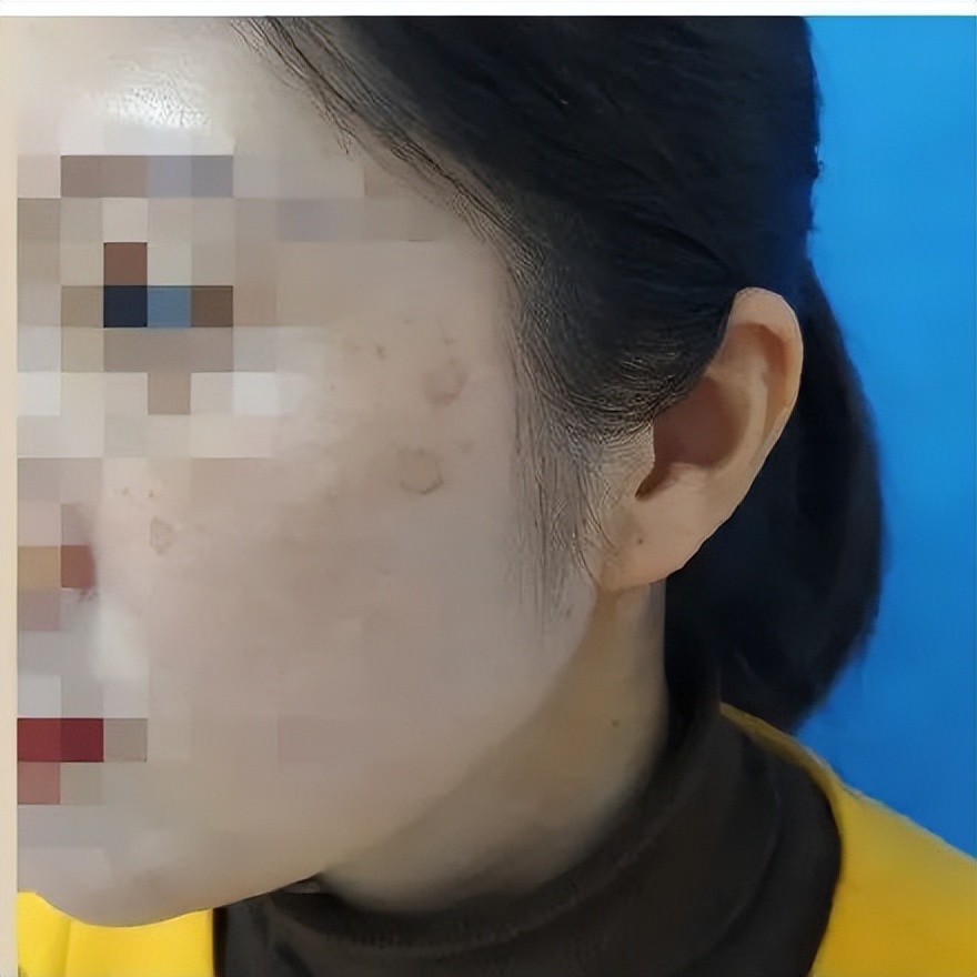 杭州90后姑娘熬夜十年长出老年斑,90后姑娘熬夜10年长出老年斑