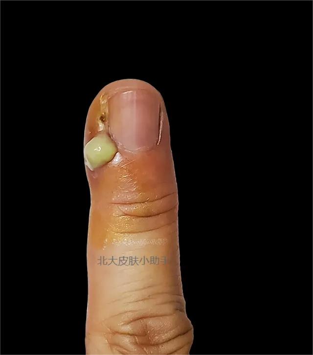 手贱，爱抠手皮、撕手皮、咬手指！指甲旁的死皮可以直接撕掉吗？