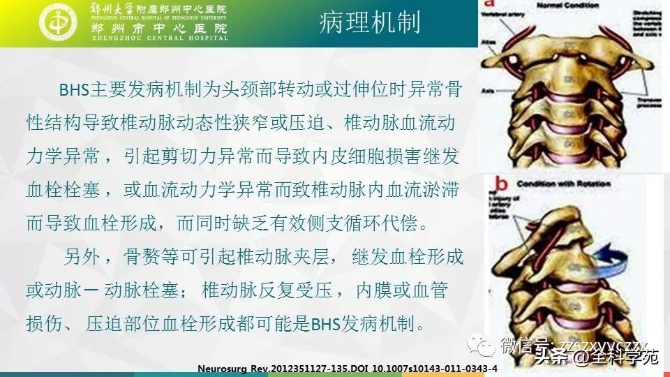 条件反射性眩晕,一种莫名的眩晕