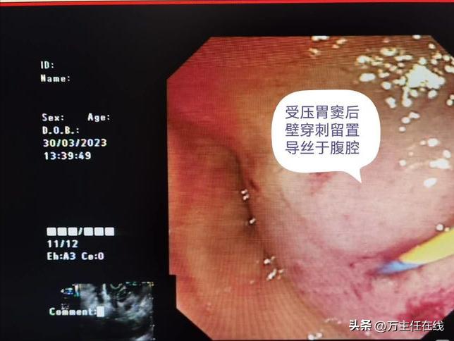 腹腔粘液癌治疗有妙招——万荣教授以内镜Notes技术成功胃减压