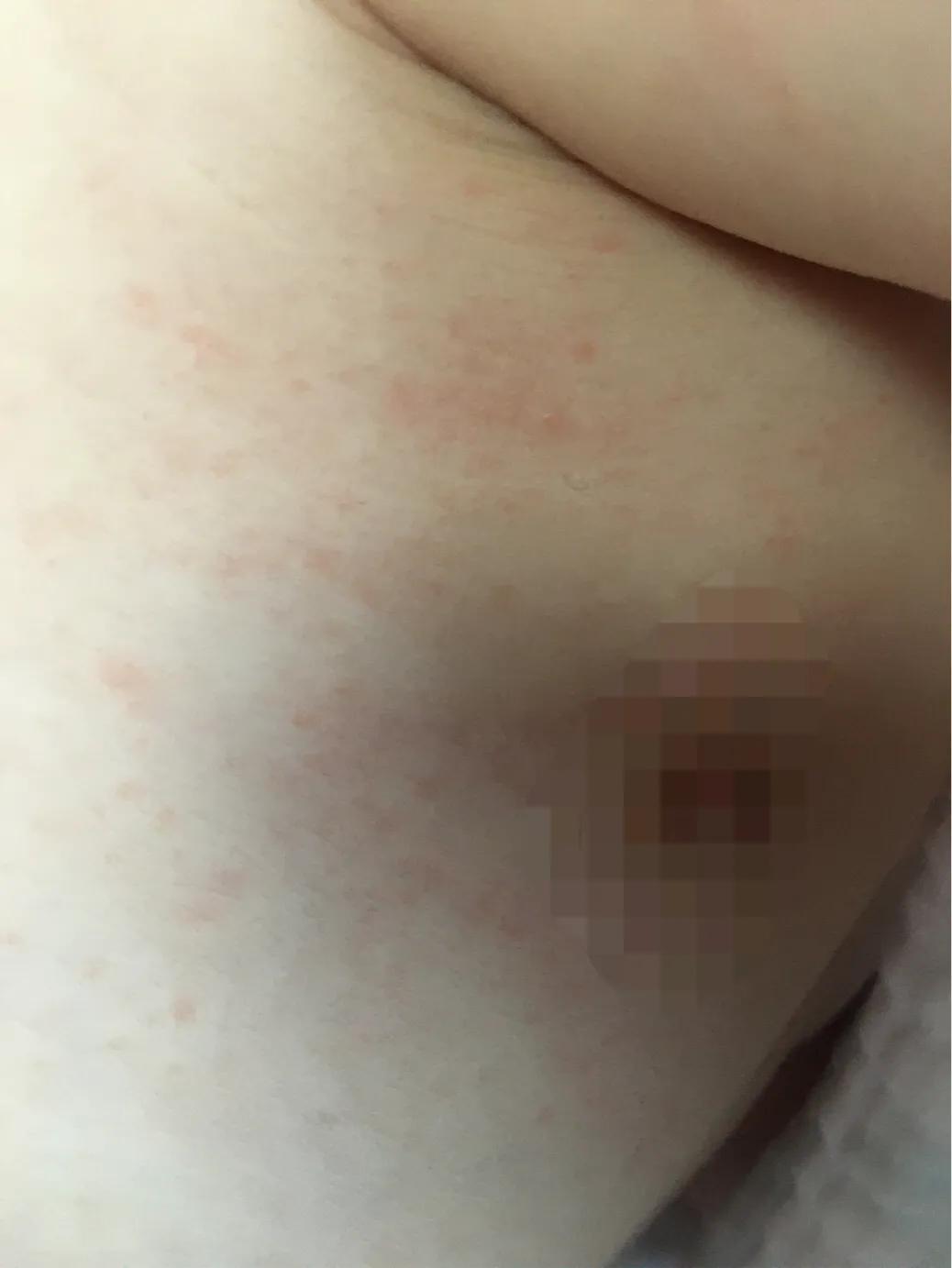 宝宝湿疹母亲有什么忌口的吗,婴儿湿疹大作战之护理的6大要点