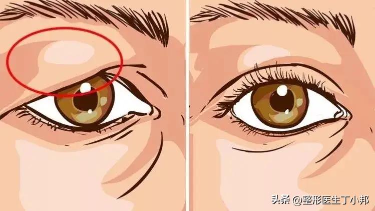 眼尾下垂眼综合可以调整吗,大小眼眼皮松弛怎么改善
