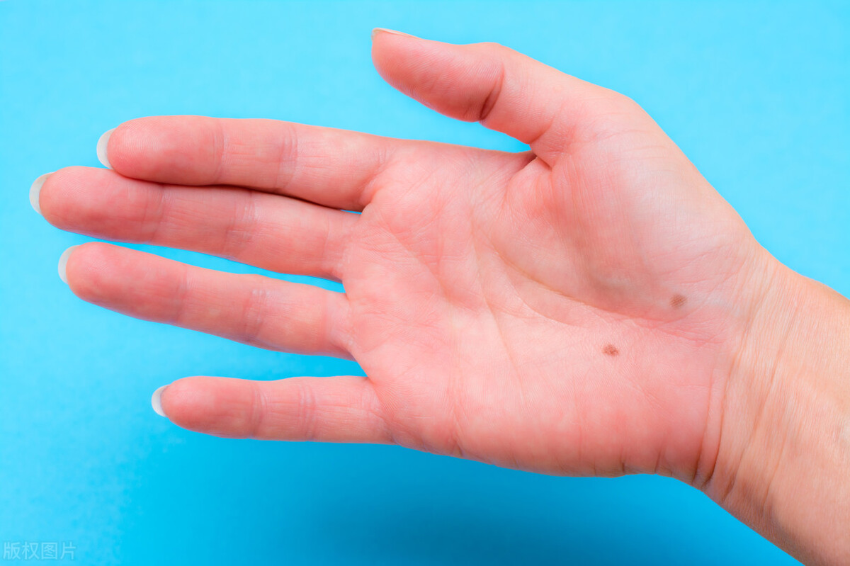 再三提醒,这三个地方有痣是癌症的前兆