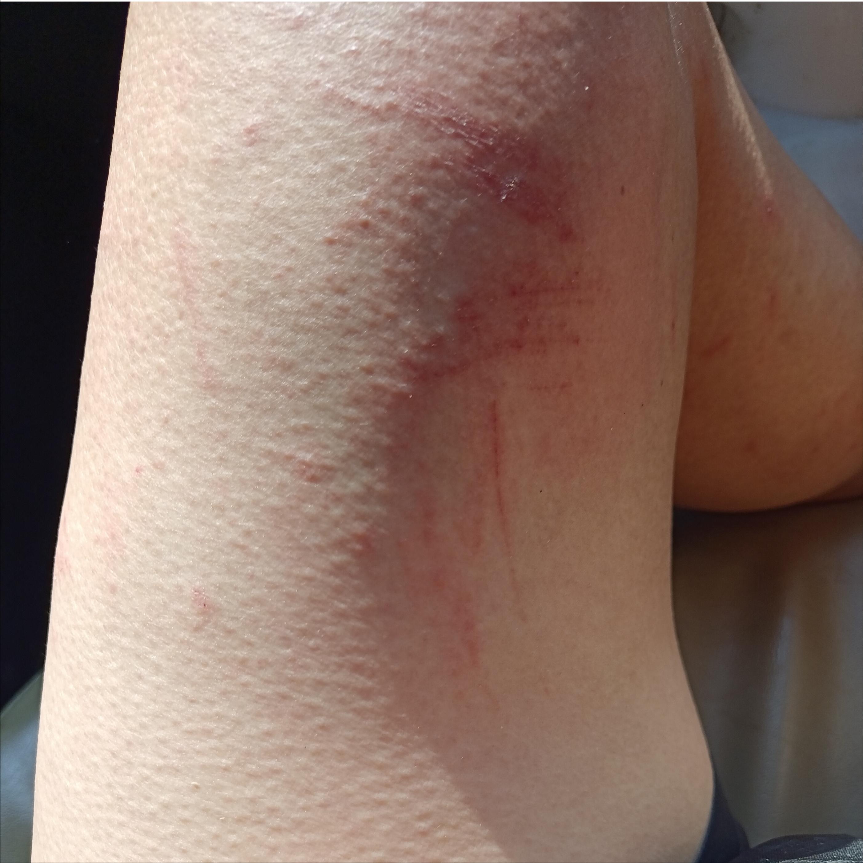 蜜蜂蛰了额头留下一片黑怎么办,我被蜜蜂蛰了