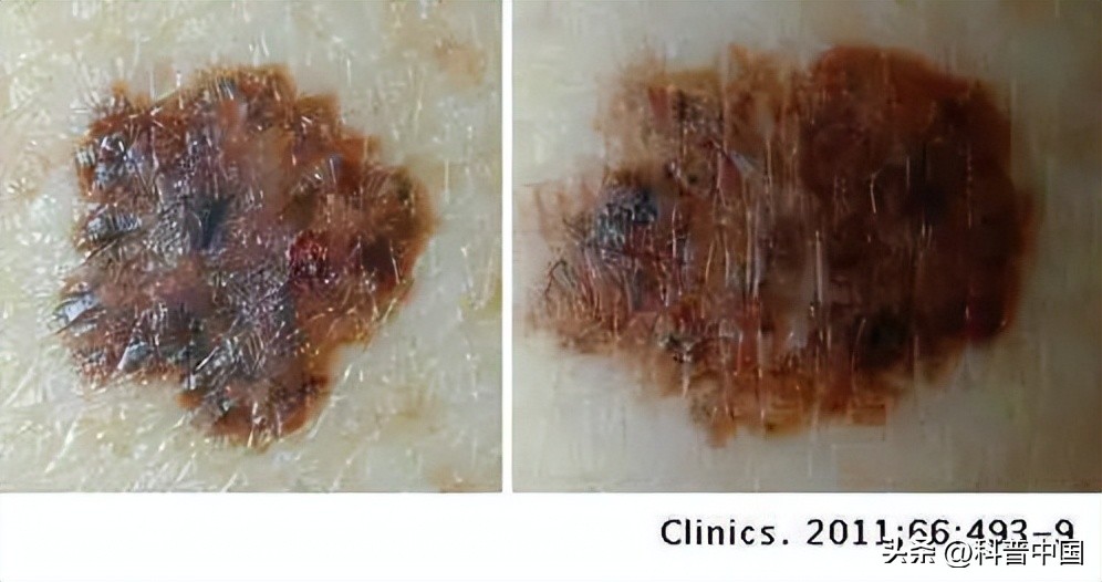 怎么判断身上的痣变癌,痣的病变到癌需要多长时间