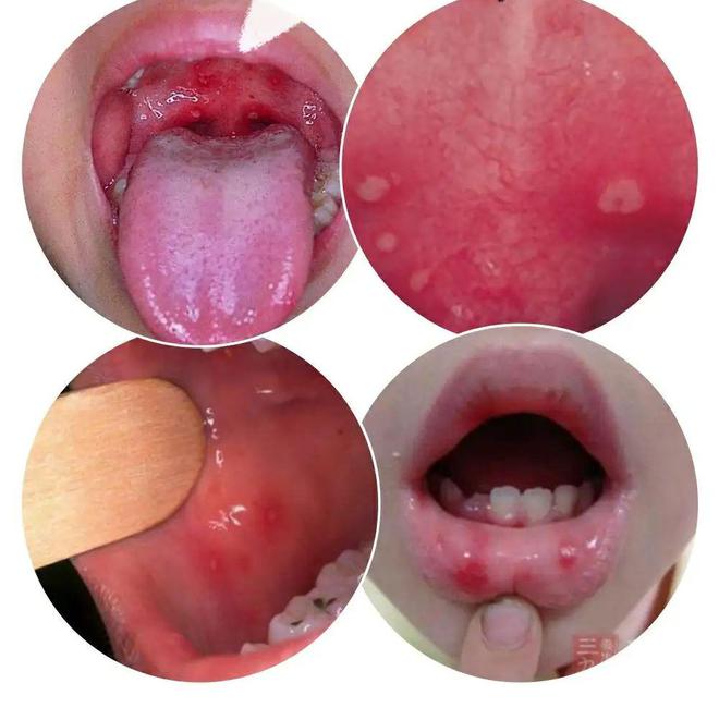 口舌生疮牙龈肿痛偏方,口舌生疮牙龈肿痛吃什么药好得快