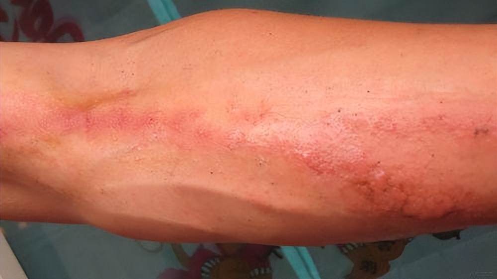 蛇盘疮越长越多怎么办,蛇盘疮腰缠一圈真的会要人命吗