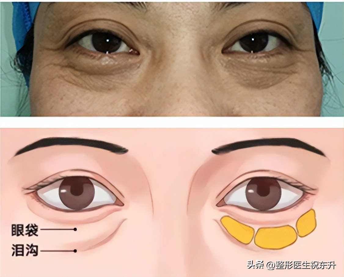做眼袋手术的真实经历,犹豫了很久终于来做眼袋手术