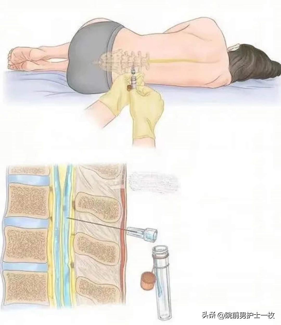 腰椎穿刺后护理注意事项,小孩做腰椎穿刺有什么影响