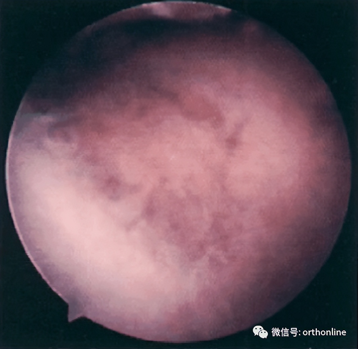 髌骨软化症的最佳疗法是什么,髌骨软化症治疗方法以及康复训练