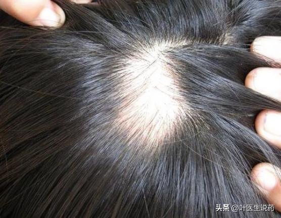 头顶开始变秃了怎么办,头顶越来越秃需要剪短吗