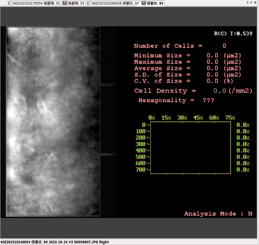 角膜不好还能做晶体植入吗,角膜不好能做近视手术吗