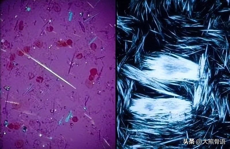 手指痛风的初期症状和治疗,脚踝痛风的症状和治疗方法