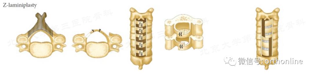 脊髓型颈椎病椎板成形术,椎间盘成形术指征