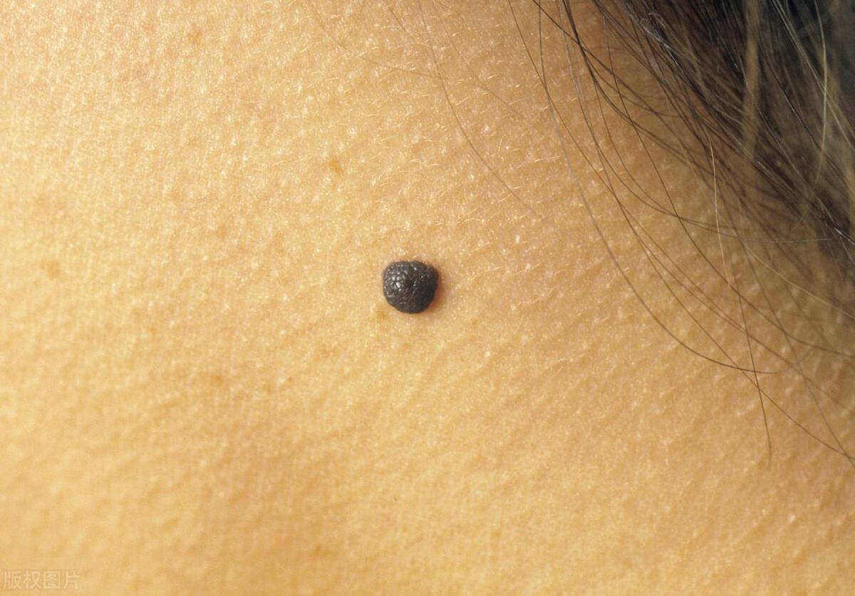 无聊去按摩,男技师说我臀部有颗肉痣,可能与癌症有关,真的吗