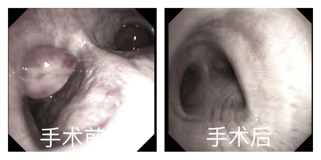 双肺梗阻,双肺阻塞