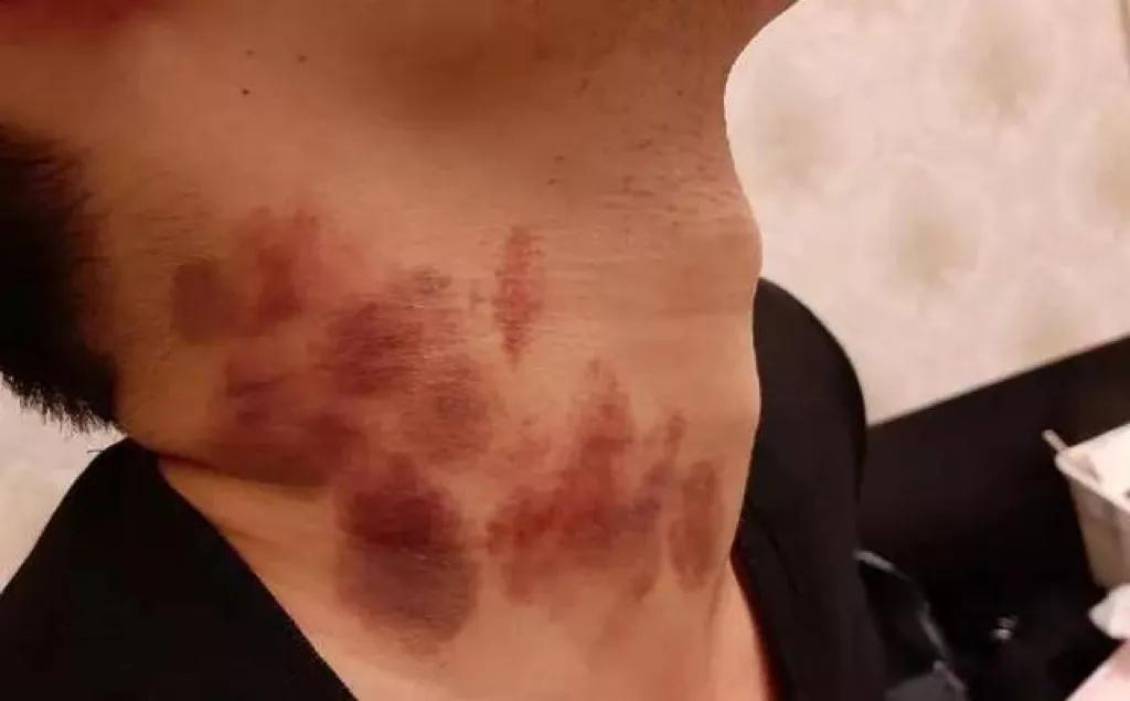 被女友留吻痕丧命,女友在男友脖子上留痕迹