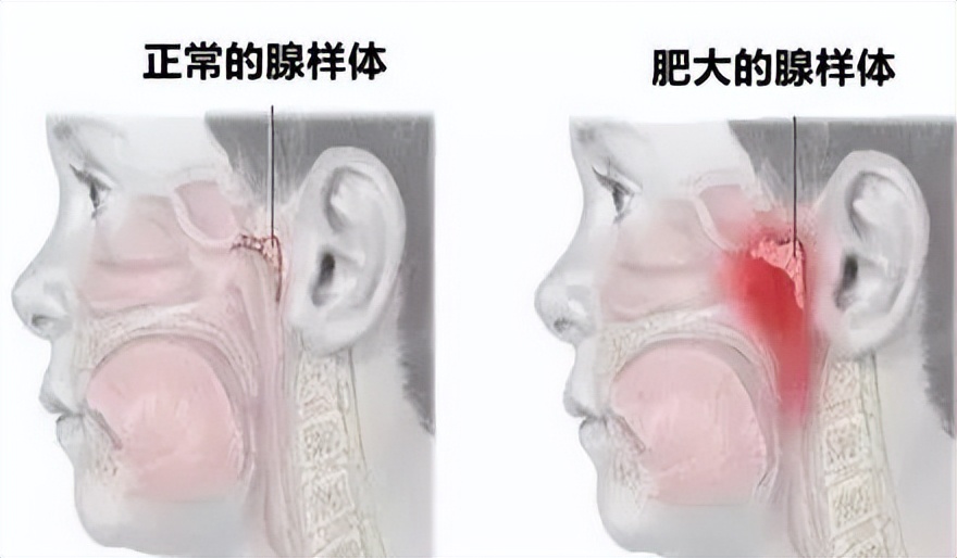 孩子一直流鼻涕怎么判断感冒,宝宝反反复复感冒流浓鼻涕怎么治