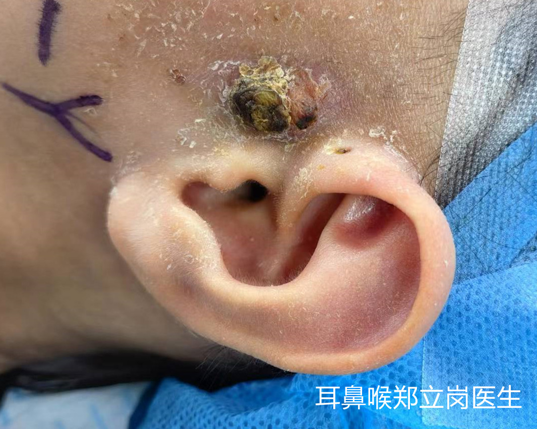 婴儿耳前瘘管红肿会自愈吗,耳瘘管红肿痛脸和脖子都肿了