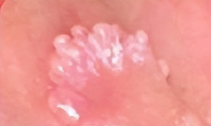 避孕套也无法100%防护！怎么治疗尖锐湿疣？