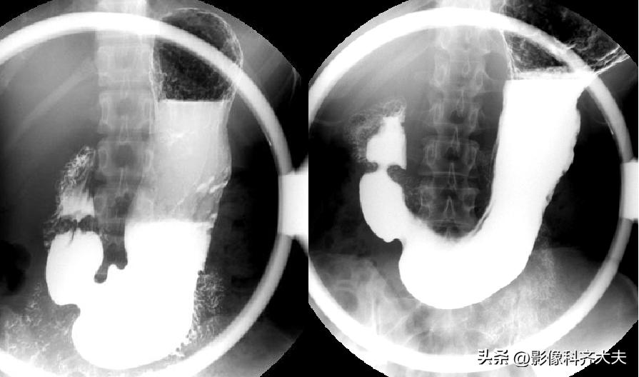 胃肠道造影超声解剖图,胃肠钡餐影像检查片子