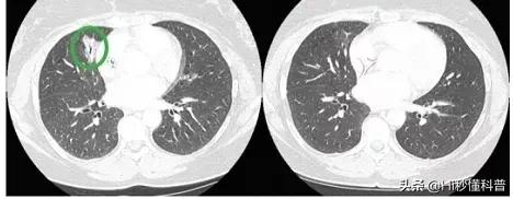 抗癌药有望彻底治愈癌吗,新抗癌药能治愈所有癌症吗