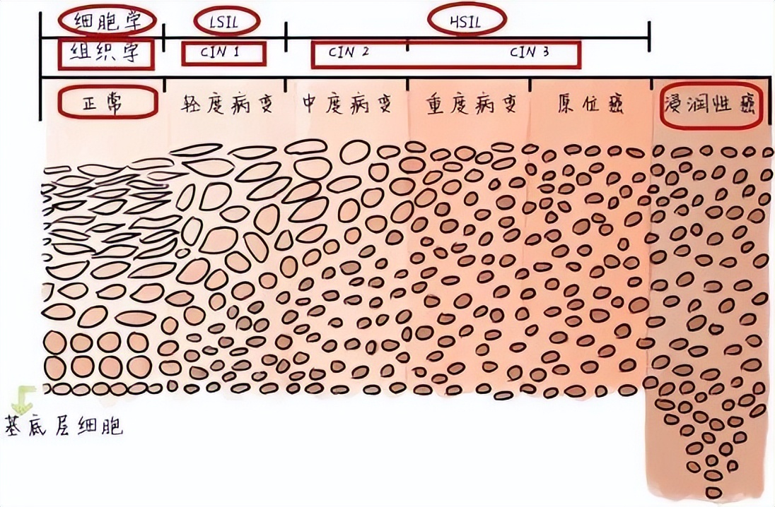 宫颈病变cin1到宫颈癌有多久,宫颈癌前病变是切宫颈还是切子宫