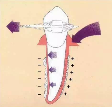 牙齿矫正有几种方式费用怎么算,好的牙齿矫正费用一般要多少钱