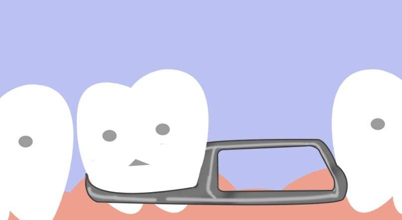 小孩换牙期门牙掉了一半怎么办,小孩门牙旁边牙齿掉了不长咋回事