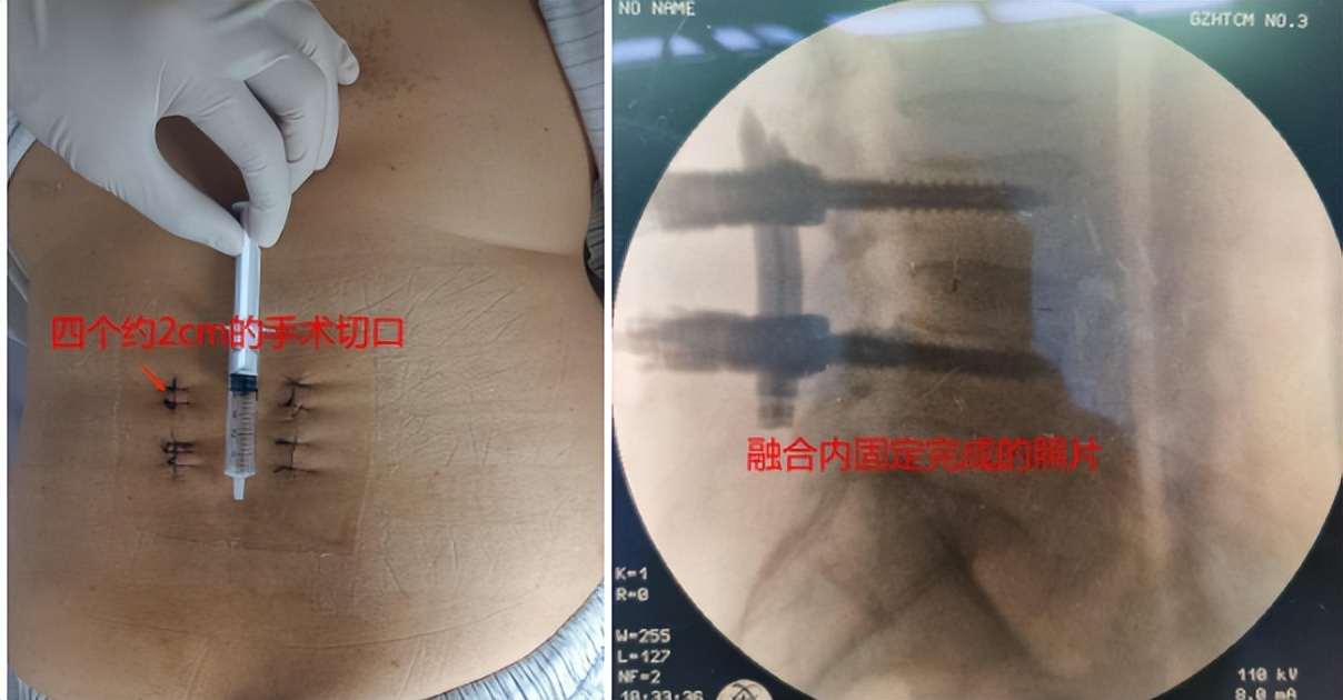 狂飙安欣受伤旧疾复发住院,狂飙安欣去医院