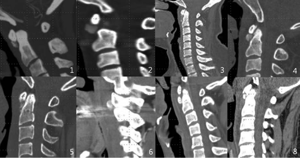 颈长肌腱炎影像表现,三头肌钙化性肌腱炎治疗
